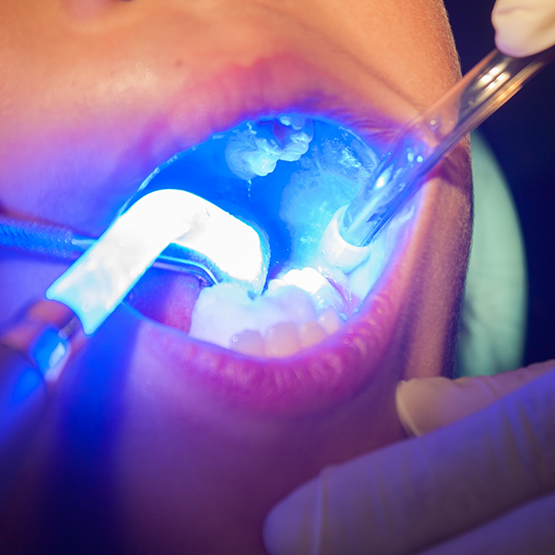 Close up of dental sealants being placed on teeth
