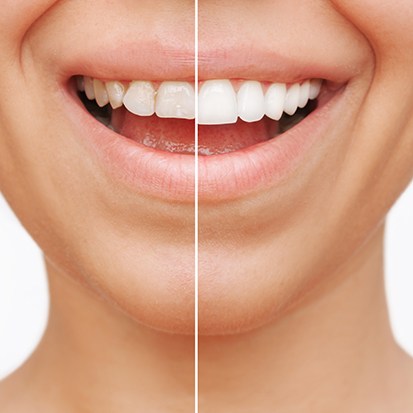 Smile split in half to show before/after cosmetic dental results