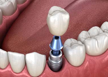 single tooth dental implant with a crown on top