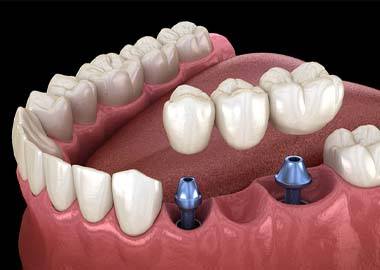 three-part dental bridge supported by two dental implants