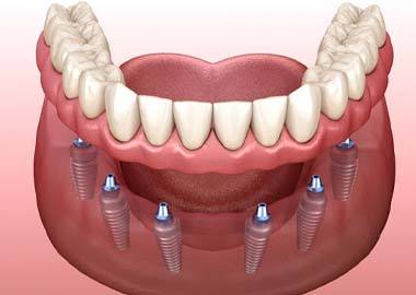 six dental implants anchoring a full denture