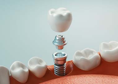 dental implant with abutment and crown