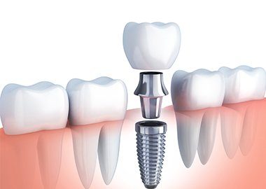 Animated implant tooth replacement