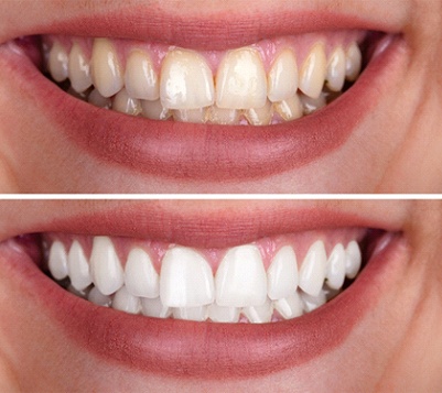 Before and after results of teeth whitening