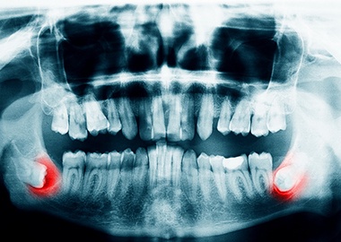 X-ray of wisdom teeth in Granby