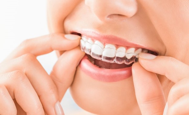 Patient placing her Invisalign tray in her mouth.