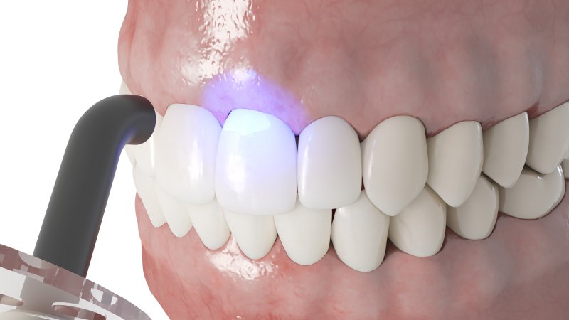 3D illustration of dental bonding