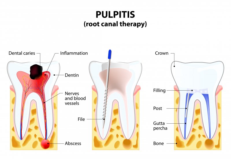 Diagram of a root canal procedure