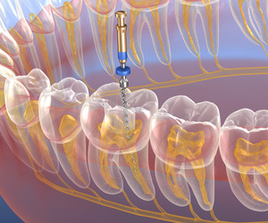 Illustration of root canal treatment being performed