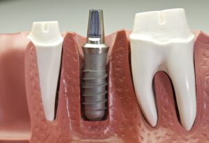 Model of dental implant in gum tissue